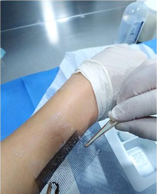 Injerto de membrana: Delicado tratamiento que solo realiza el Hospital San Pablo de Coquimbo