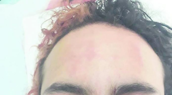 Asegura ser víctima de una bomba lacrímogena que le impactó en el rostro